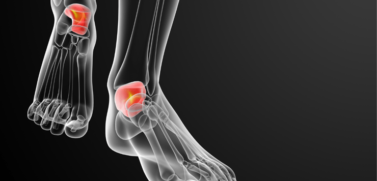 Achilles Tendon Case Study: Using the LymphaTouch
